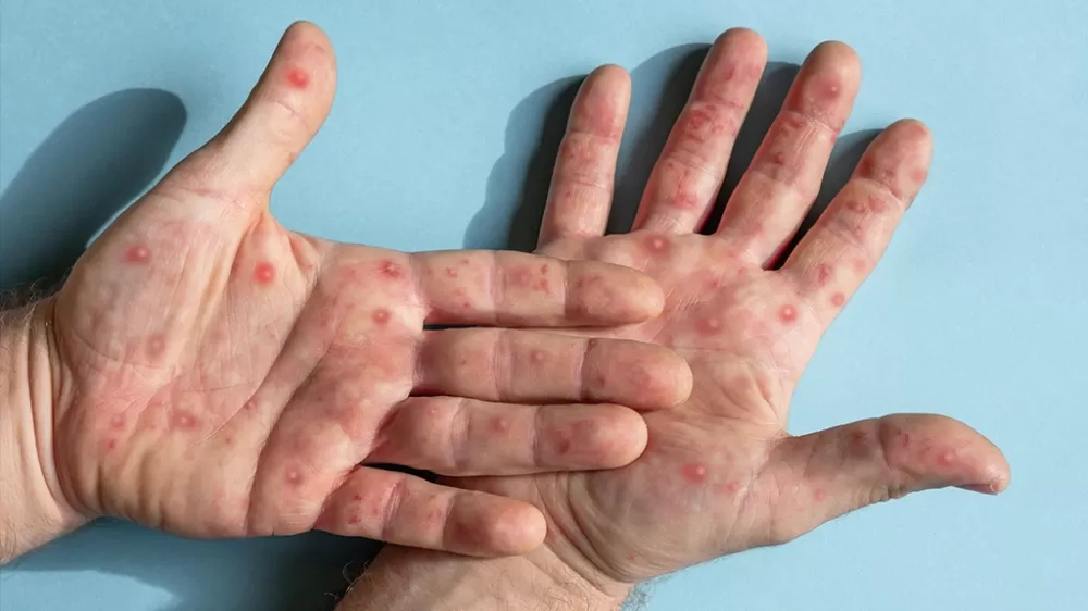 Minas Gerais registra 13 casos confirmados de mpox