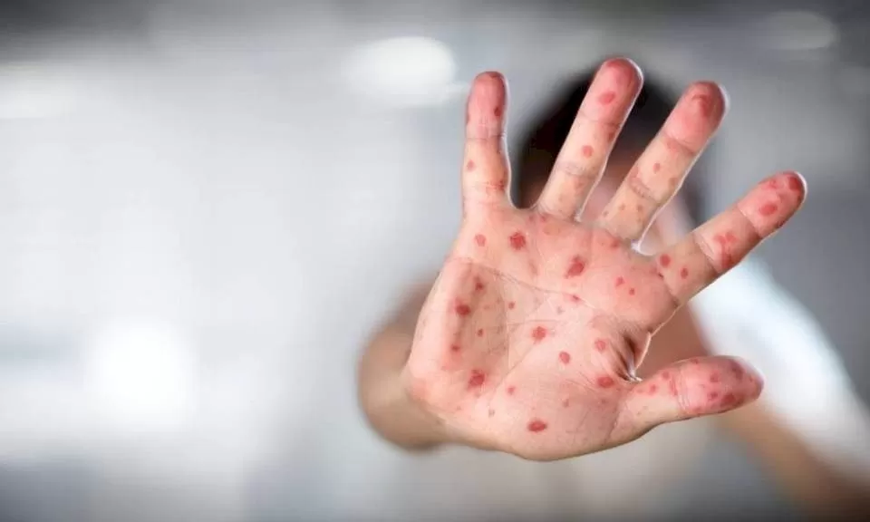 Betim confirma caso de meningite bacteriana em criança de 11 anos