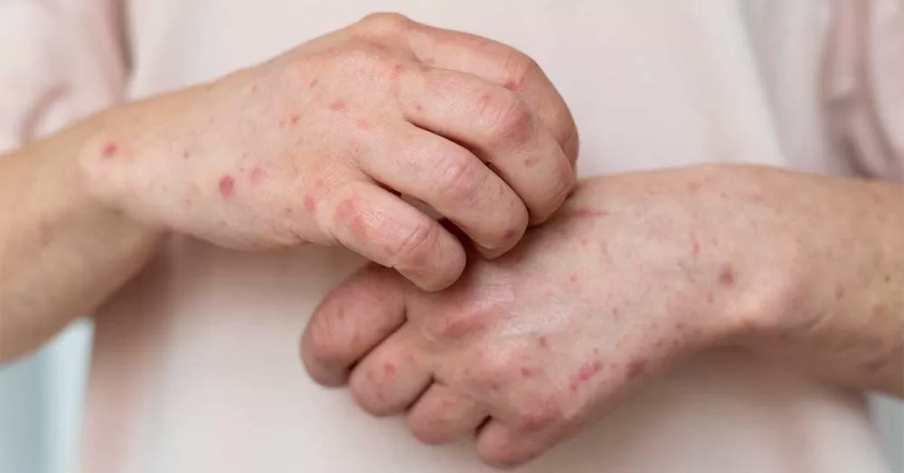Dermatite atópica pode afetar pele, sono e autoestima; veja sintomas e tratamento