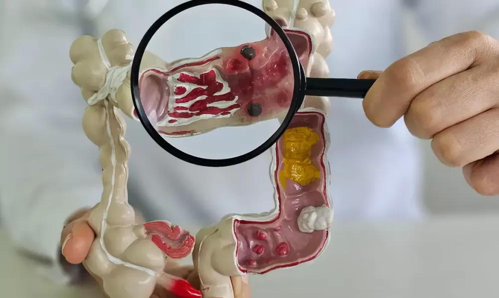 Casos de doenças inflamatórias intestinais aumentam cinco vezes em 13 anos no Brasil
