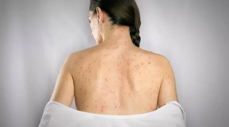 Nova York declara emergência por surto de sarampo e amplia vacinação