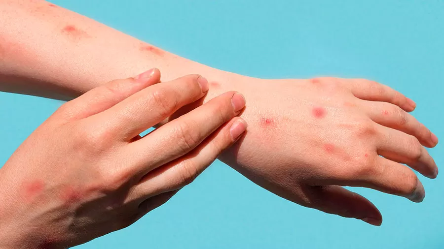 OMS declara mpox como emergência de saúde pública global