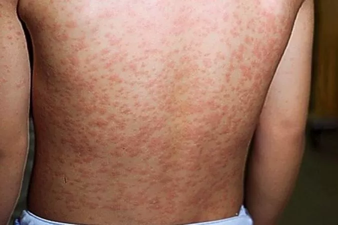 Minas Gerais confirma caso de Sarampo