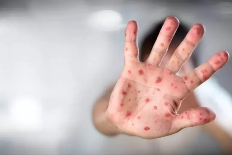 Mais de 80% dos municípios brasileiros enfrentam risco elevado de retorno do sarampo