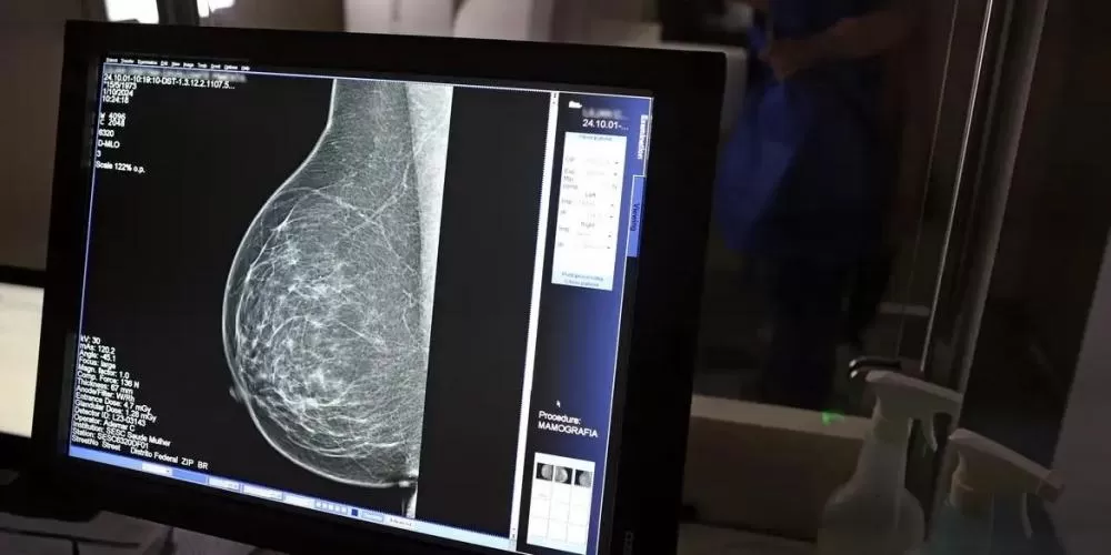 Cerca de 2,2 mil mulheres em Minas aguardam mamografia pelo SUS, com espera superior a 50 dias