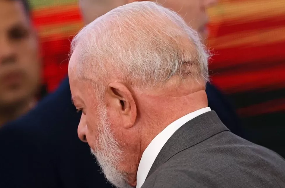 Lula passará por um novo procedimento para evitar sangramentos no cérebro
