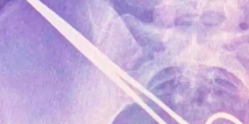 Médico esquece pinça na coluna de paciente e é condenado a pagar R$ 50 mil