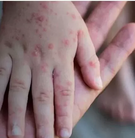 Sete Lagoas registra suspeita de mpox em duas crianças de escola da rede pública