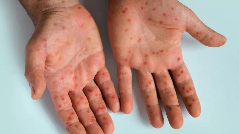 Tudo o que você precisa saber sobre a Mpox, doença com um caso confirmado pela Prefeitura de Lagoa Santa