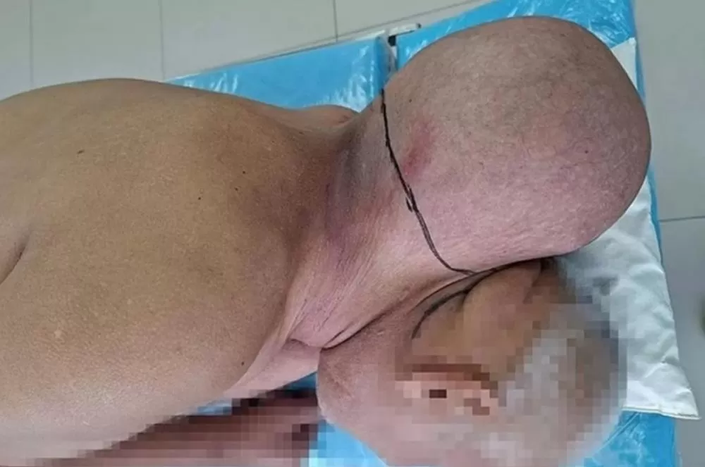Homem convive 16 anos com tumor gigante e só busca ajuda após crescimento extremo