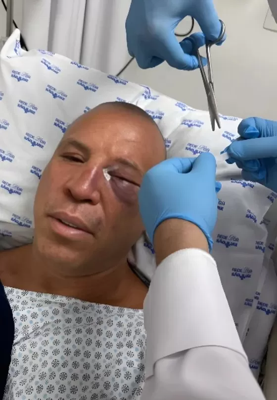 Wanderlei Silva sofre fratura no nariz após briga generalizada em luta contra Popó